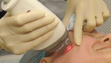 كيف يتم إجراء تجديد الجلد الجزئي؟